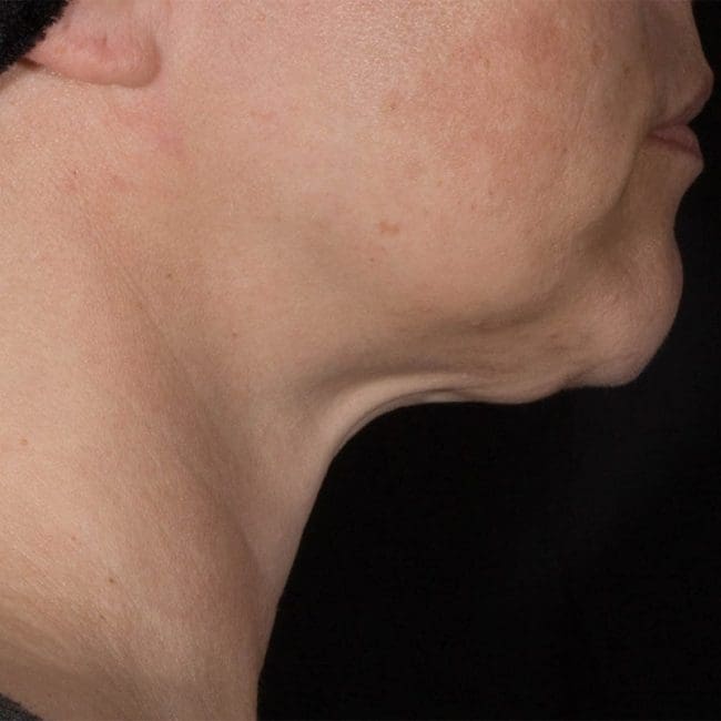 Potenza RF Microneedling Before and After - Case -1, Image 1 - Female, age 45 – 54 - Montréal & Saint-Sauveur, QC - Clinique AG