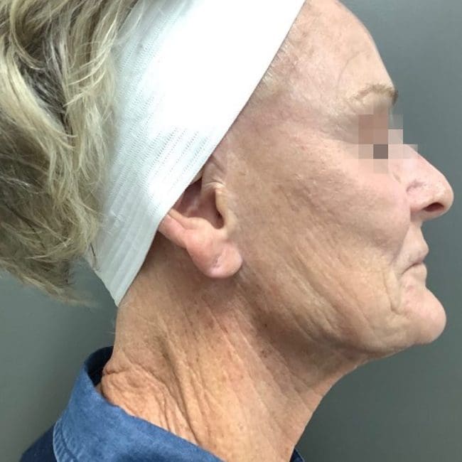 Potenza RF Microneedling Before and After - Case 2, Image 1 - Female, age 55 – 64 - Montréal & Saint-Sauveur, QC - Clinique AG