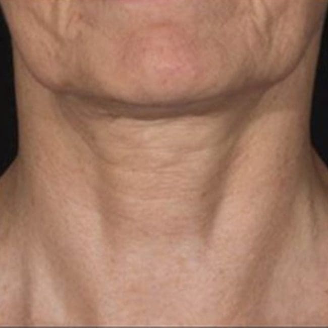 Potenza RF Microneedling Before and After - Case 3, Image 1 - Female, age 45 – 54 - Montréal & Saint-Sauveur, QC - Clinique AG