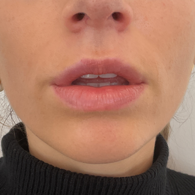 Dermal Fillers Before and After - Case 10, Image 2 - Female, age 25 – 34 - Montréal & Saint-Sauveur, QC - Clinique AG