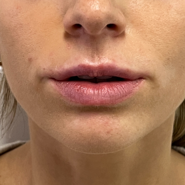 Dermal Fillers Before and After - Case 10, Image 1 - Female, age 25 – 34 - Montréal & Saint-Sauveur, QC - Clinique AG