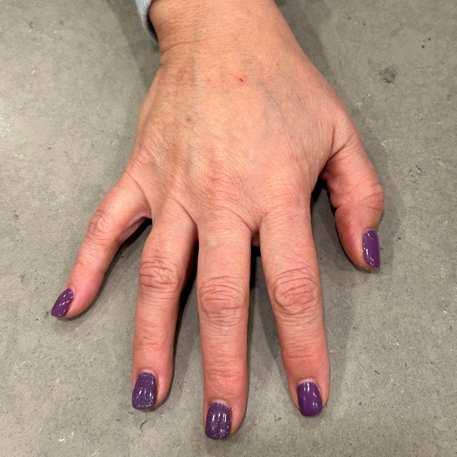 Dermal Fillers Before and After - Case 11, Image 2 - Female, age 45 – 54 - Montréal & Saint-Sauveur, QC - Clinique AG