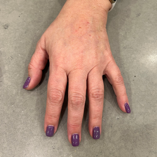 Dermal Fillers Before and After - Case 11, Image 4 - Female, age 45 – 54 - Montréal & Saint-Sauveur, QC - Clinique AG