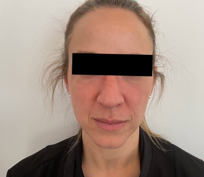 Dermal Fillers Before and After - Case 7, Image 2 - Female, age 45 – 54 - Montréal & Saint-Sauveur, QC - Clinique AG