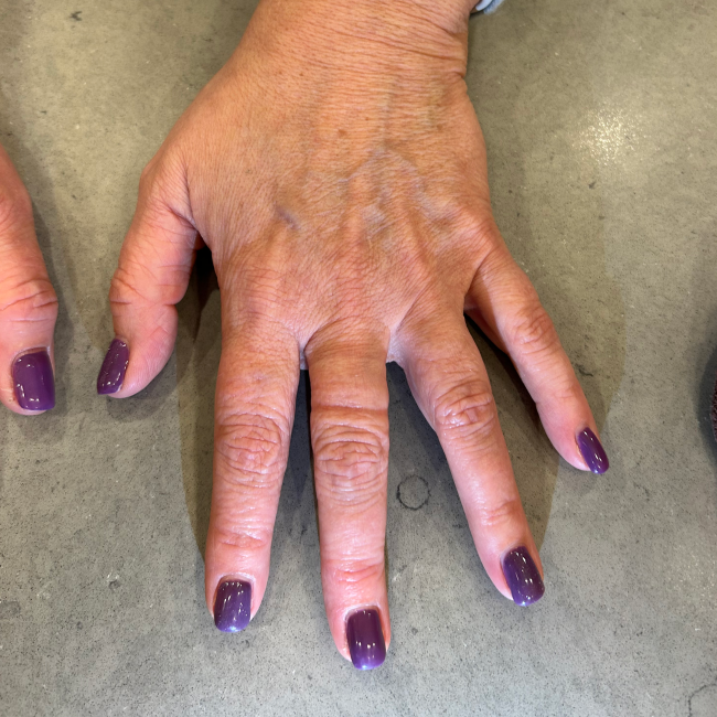 Dermal Fillers Before and After - Case 11, Image 3 - Female, age 45 – 54 - Montréal & Saint-Sauveur, QC - Clinique AG