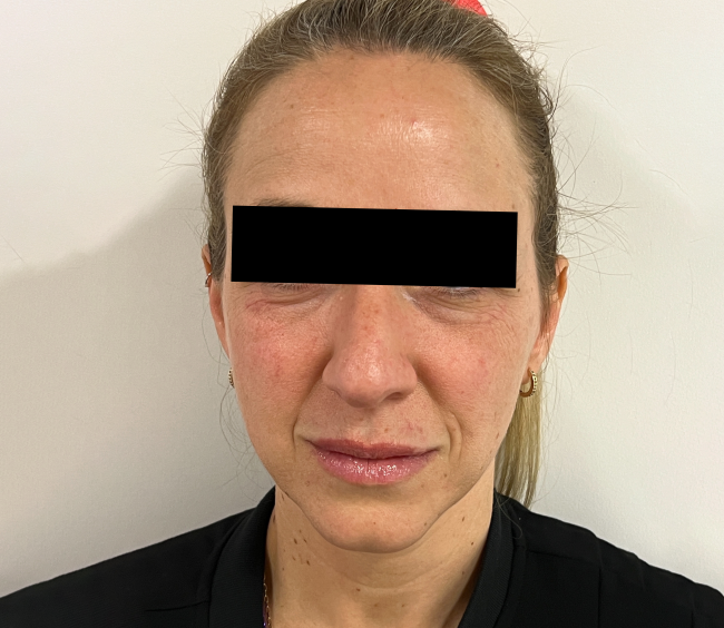 Dermal Fillers Before and After - Case 7, Image 1 - Female, age 45 – 54 - Montréal & Saint-Sauveur, QC - Clinique AG