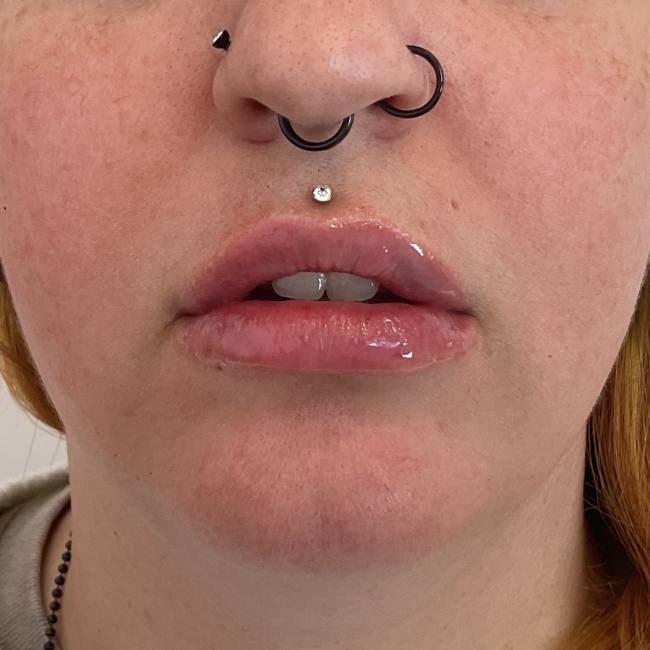 Produits de comblement cutané Before and After - Case -1, Image 2 - Female, age 35 – 44 - Montréal & Saint-Sauveur, QC - Clinique AG