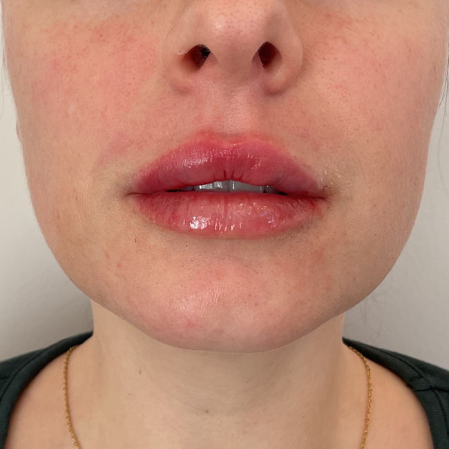 Dermal Fillers Before and After - Case 8, Image 2 - Female, age 25 – 34 - Montréal & Saint-Sauveur, QC - Clinique AG