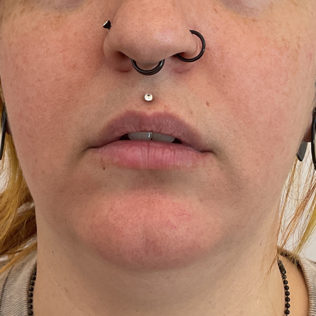 Produits de comblement cutané Before and After - Case -1, Image 1 - Female, age 35 – 44 - Montréal & Saint-Sauveur, QC - Clinique AG