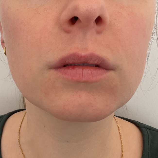 Dermal Fillers Before and After - Case 8, Image 1 - Female, age 25 – 34 - Montréal & Saint-Sauveur, QC - Clinique AG