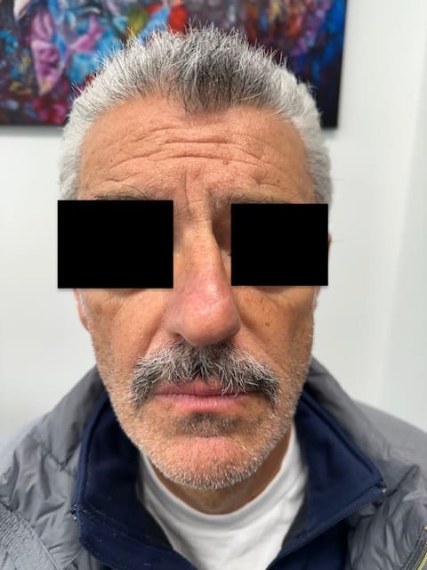 Rhinoplastie Before and After - Case -1, Image 1 - Male, age 45 – 54 - Montréal & Saint-Sauveur, QC - Clinique AG