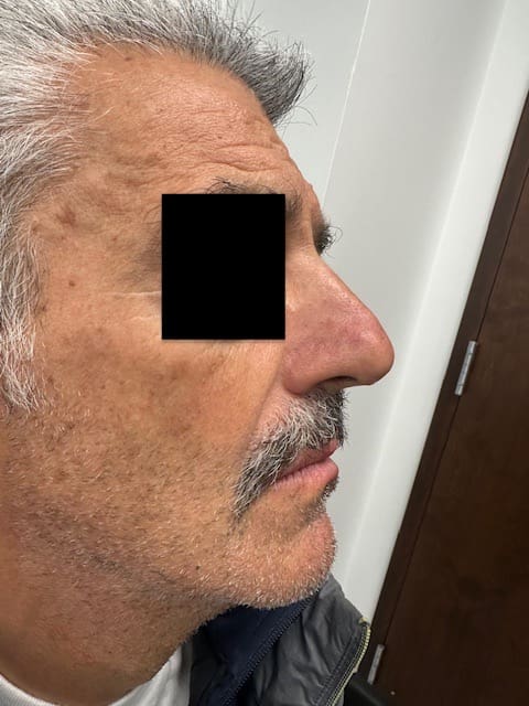 Rhinoplastie Before & Afters | Clinique AG