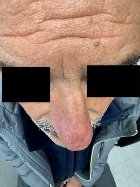 Rhinoplastie Before and After - Case 2, Image 1 - Male, age 45 – 54 - Montréal & Saint-Sauveur, QC - Clinique AG