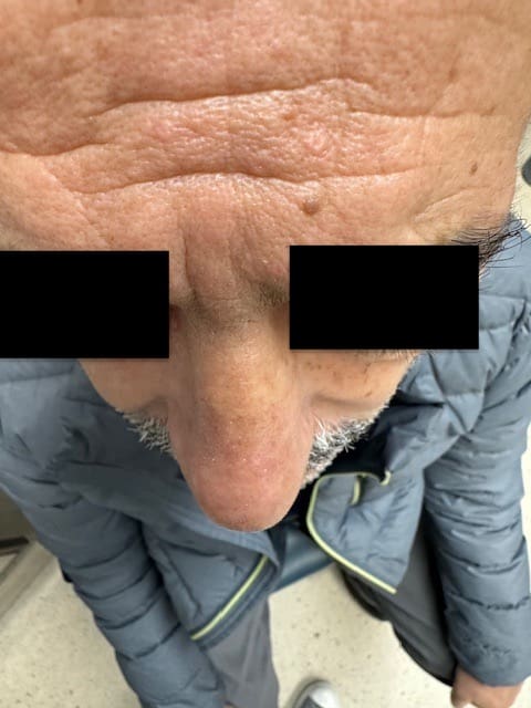 Rhinoplastie Before and After - Case 2, Image 2 - Male, age 45 – 54 - Montréal & Saint-Sauveur, QC - Clinique AG