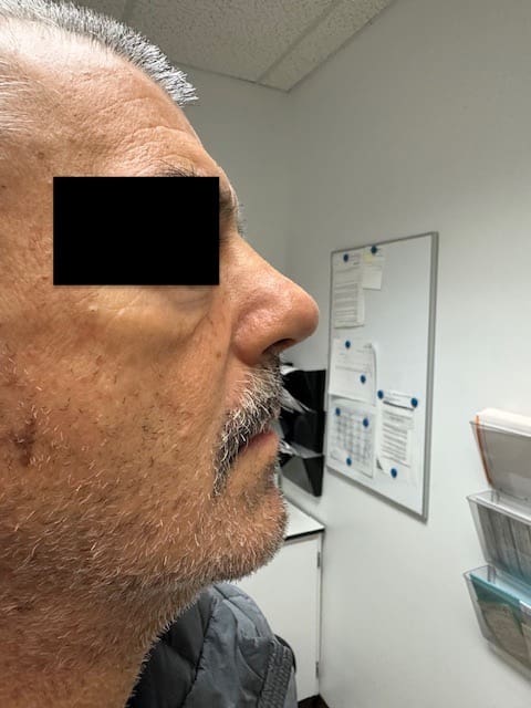 Rhinoplastie Before & Afters | Clinique AG