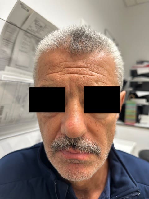 Rhinoplastie Before and After - Case -1, Image 2 - Male, age 45 – 54 - Montréal & Saint-Sauveur, QC - Clinique AG