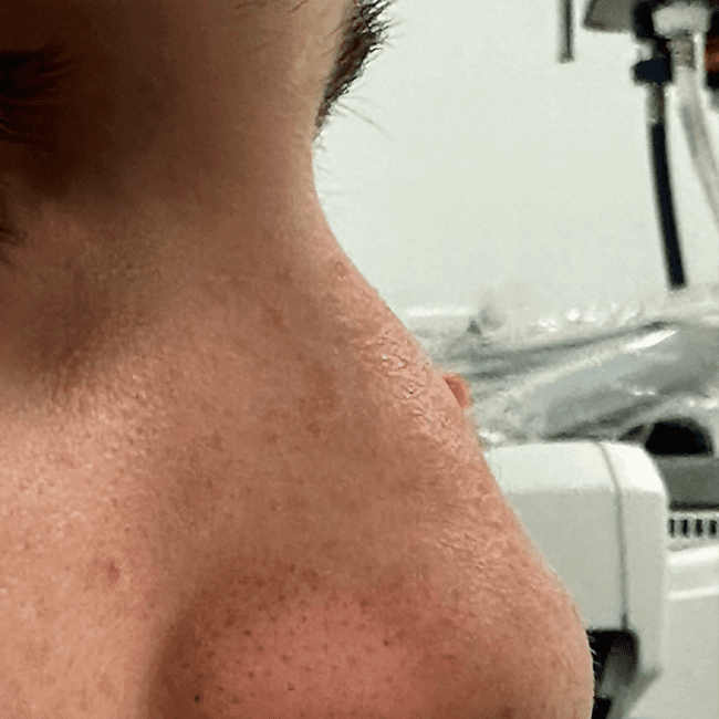 Rhinoplastie Before and After - Case 4, Image 1 - Female, age 25 – 34 - Montréal & Saint-Sauveur, QC - Clinique AG