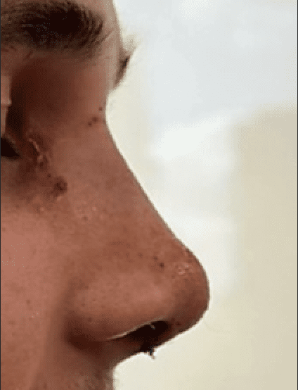 Rhinoplastie Before and After - Case 4, Image 2 - Female, age 25 – 34 - Montréal & Saint-Sauveur, QC - Clinique AG