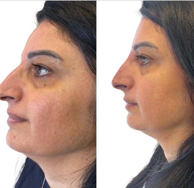 Rhinoplastie liquide Before & Afters | Clinique AG