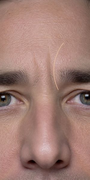 between-brow line concerns