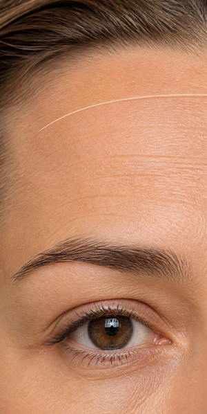 forehead line concerns