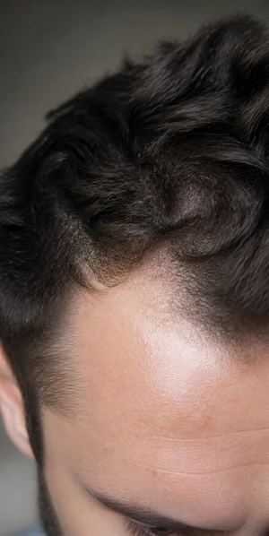 receding hairline concern