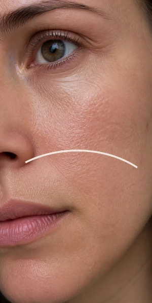 Détail de la joue illustrant des objectifs d'hydratation avec la revitalisation cutanée injectable