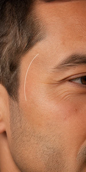 temple care after facial PRP