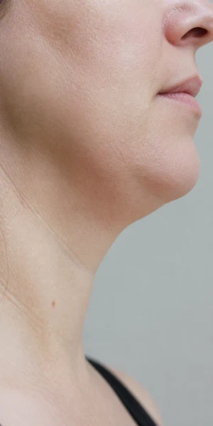 temporary response after lipolysis